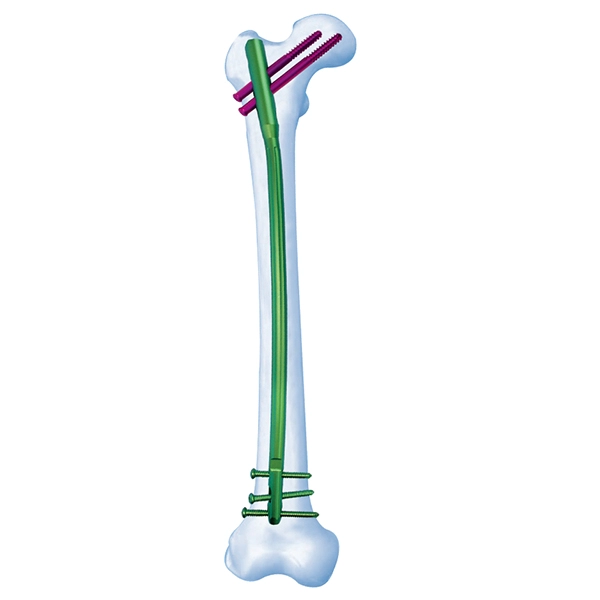 UFN Universal Femoral Nail II